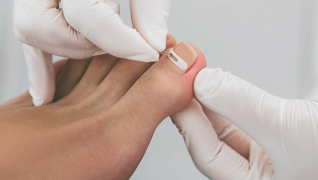 Medizinische Fußpflege im Ostalbkreis